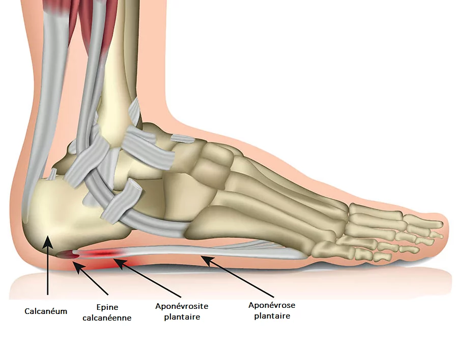 aponevrose plantaire kine du sport montpellier ondes de choc 